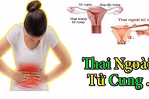 Cách phòng ngừa thai ngoài tử cung