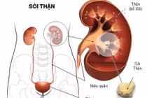 Sỏi niệu quản 1/3 trên có tán được không?