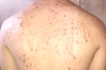 Lý giải tại sao mụn lưng nhiều và cách phòng tránh 