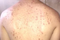 Lý giải tại sao mụn lưng nhiều và cách phòng tránh 