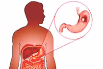 Nhận biết loại polyp dạ dày dễ ung thư