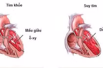 Tránh tăng huyết áp gây bệnh mạch vành