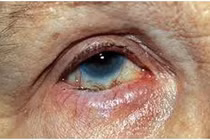 Quặm mi bẩm sinh