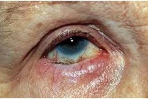 Quặm mi bẩm sinh