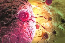 Nghiên cứu mới điều trị ung thư không sử dụng hóa trị và xạ trị