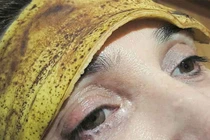 Cơn đau nửa đầu biến mất nhờ vỏ chuối