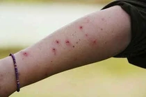 Xử lý vết côn trùng cắn, đốt