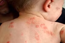 Dùng mẹo dân gian chữa vết côn trùng cắn