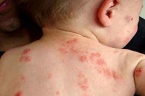 Dùng mẹo dân gian chữa vết côn trùng cắn