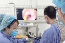 Xương cá 6cm đâm tá tràng