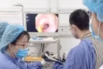 Xương cá 6cm đâm tá tràng