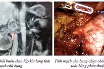 Robot cắt ung thư thận và lấy chồi bướu trong lòng tĩnh mạch