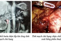 Robot cắt ung thư thận và lấy chồi bướu trong lòng tĩnh mạch