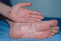 Chủ quan khi xét nghiệm giang mai âm tính 