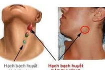 Hạch to không đau cẩn thận u lympho ác tính không Hodgkin