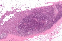 Hạt nano gây mê tấn công tế bào thần kinh để ức chế khối u