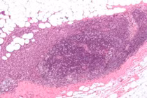 Hạt nano gây mê tấn công tế bào thần kinh để ức chế khối u