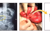 Bé gái 4 tuổi thủng ruột vì nuốt bi nam châm trong đồ chơi