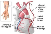 Mổ bắc cầu nối động mạch vành