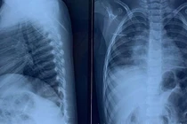 Nội soi lấy kim khâu trong ngực trẻ 3 tuổi