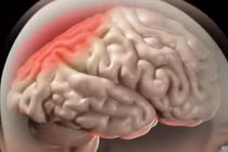 Phù não khi điều trị ung thư