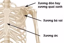 Gãy xương đòn lâu liền