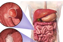 Ung thư di căn vì uống thuốc Nam