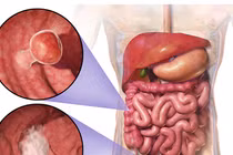 Ung thư di căn vì uống thuốc Nam