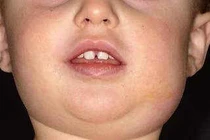 Các bài thuốc trị quai bị