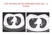 Hết u phổi và u não di căn sau 1,5 tháng điều trị