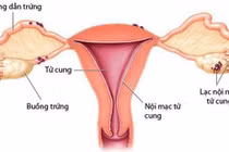 Lạc nội mạc tử cung.