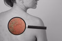 Cải thiện bệnh vảy nến mủ an toàn, hiệu quả nhờ sản phẩm thảo dược