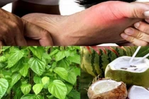 Uống nước dừa ngâm lá trầu không khỏi gút?