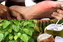 Uống nước dừa ngâm lá trầu không khỏi gút?