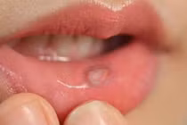 Miệng khô, có vết loét