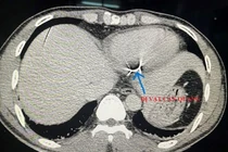 Đi cắt cỏ bị dây thép gai đâm vào tim