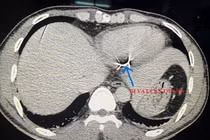 Đi cắt cỏ bị dây thép gai đâm vào tim