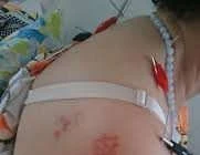 Châm cứu trị zona thần kinh