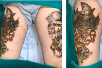 Hai đùi loét nặng sau xóa xăm tại spa