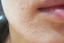 Các bài thuốc cổ chữa 4 thể chứng bệnh vảy nến