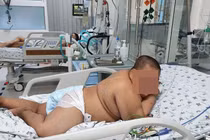 Nhiễm trùng do tụ cầu vàng từ vài vết xước nhỏ