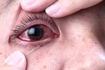 Hỏng mắt vì tự lấy dị vật
