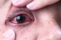 Hỏng mắt vì tự lấy dị vật