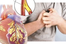 Đau ngực khác nhau nhưng đều kết luận bệnh mạch vành