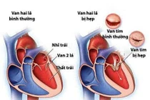 Hẹp van hai lá ở phụ nữ mang thai