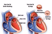 Hẹp van hai lá ở phụ nữ mang thai