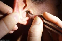 Viêm tai vì thích lấy ráy tai ngoài hiệu