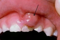 Tưởng sưng miệng do xương đâm nào ngờ ung thư