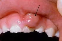 Tưởng sưng miệng do xương đâm nào ngờ ung thư