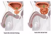 Tiền liệt tuyến sinh u